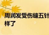 周润发受伤缝五针具体情况如何发哥现在怎么样了