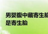 男婴腹中藏寄生胎  男婴肚子里竟有孩子什么是寄生胎