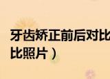 牙齿矫正前后对比照片明星（牙齿矫正前后对比照片）