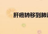 肝癌转移到肺还能活多久（ganai）