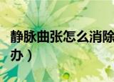 静脉曲张怎么消除最快小妙招（静脉曲张怎么办）