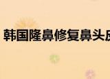 韩国隆鼻修复鼻头皮肤（韩国隆鼻手术价格）