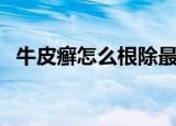 牛皮癣怎么根除最快方法（牛皮癣怎么办）
